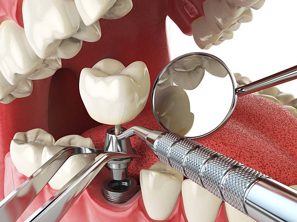 Best Emergency Dentist for Lost Fillings or Crowns in Hamshire, TX